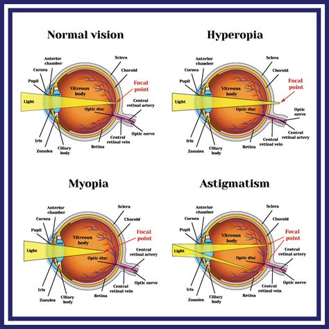 How Do Contact Lenses Work The Science Behind Them Lenspure