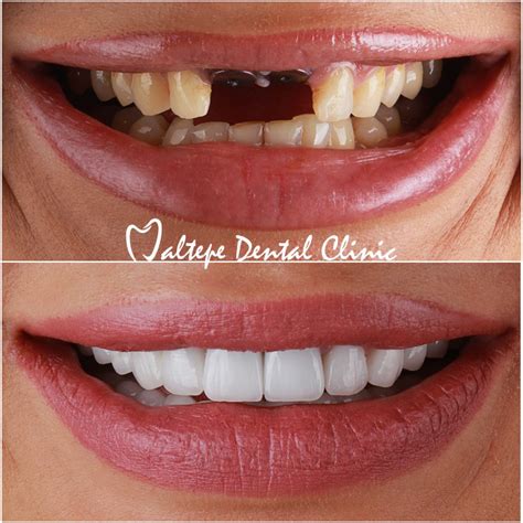 Perfect Teeth What Can You Do To Have Maltepe Dental Clinic