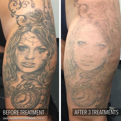 Treatment Progress Tailored Tattoo Removal Melbourne